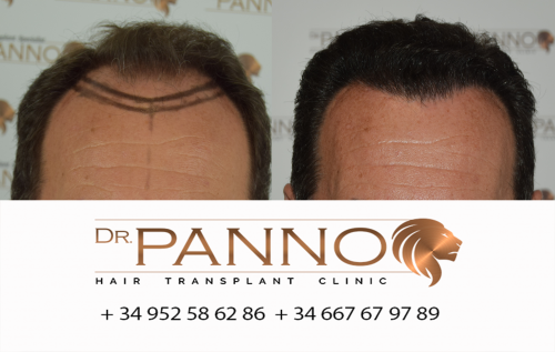 Foto Cl�nica de Trasplante Capilar Dr. Panno